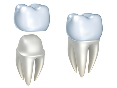 Diagram of two teeth with crowns at Roane Family Dental in West Linn, OR.