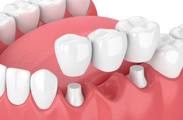 Rendering of jaw with dental bridge at Roane Family Dental.