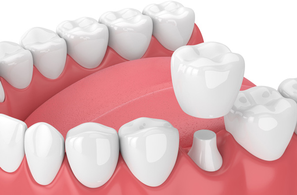 Rendering of jaw with dental crown in West Linn, OR at Roane Family Dental.