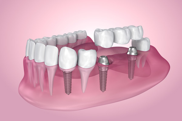 3D rendering of mouth with multiple dental implants at Roane Family Dental in West Linn, OR