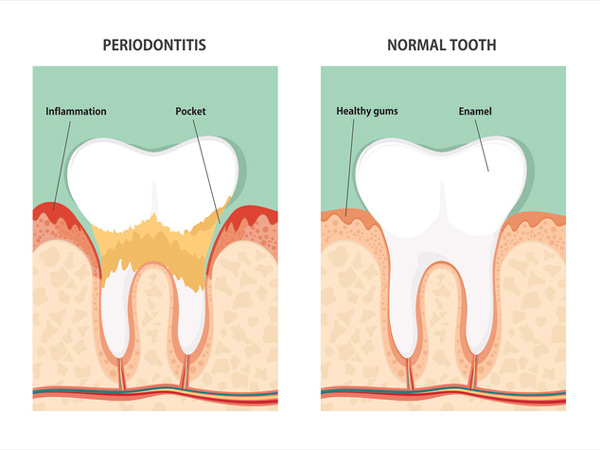 Diagram of a tooth with periodontitis and a healthy tooth at Roane Family Dental in West Linn, OR.