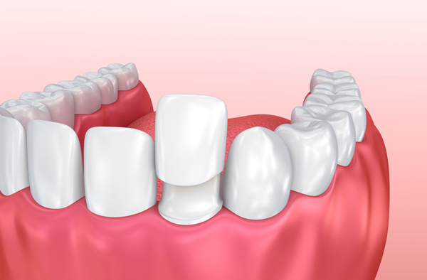 Rendering of jaw with porcelain veneer on tooth at Roane Family Dental in West Linn, OR.