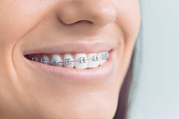 Close up of smiling woman with metal braces at Roane Family Dental in West Linn, OR