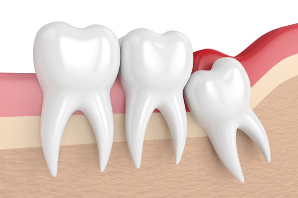 Illustration of an impacted wisdom tooth at Roane Family Dental in West Linn, OR