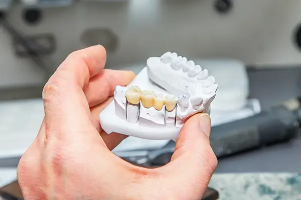 Hand holding a dental model with a fixed dental bridge at Roane Family Dental in West Linn, OR