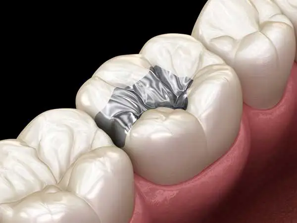 A close-up of a molar with an amalgam dental filling, illustrated by Roane Family Dental in West Linn, OR